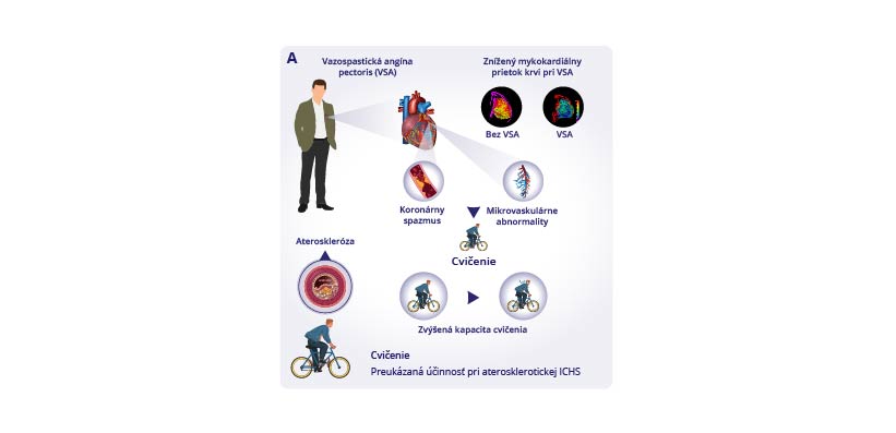 Cvičenie sa ukázalo ako užitočné u pacientov s vazospastickou angínou pectoris